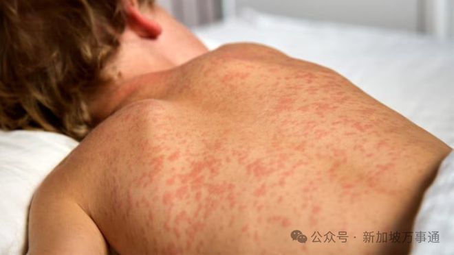 新加坡加强防控麻疹疫情，女婴确诊致4人因密接被隔离